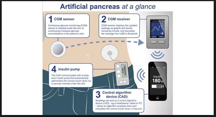 Technische Fortschritte auf dem Weg zu einer „künstlichen Bauchspeicheldrüse“, die den natürlichen  Prozess simuliert